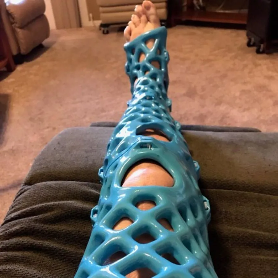 3d printed cast so she can shower