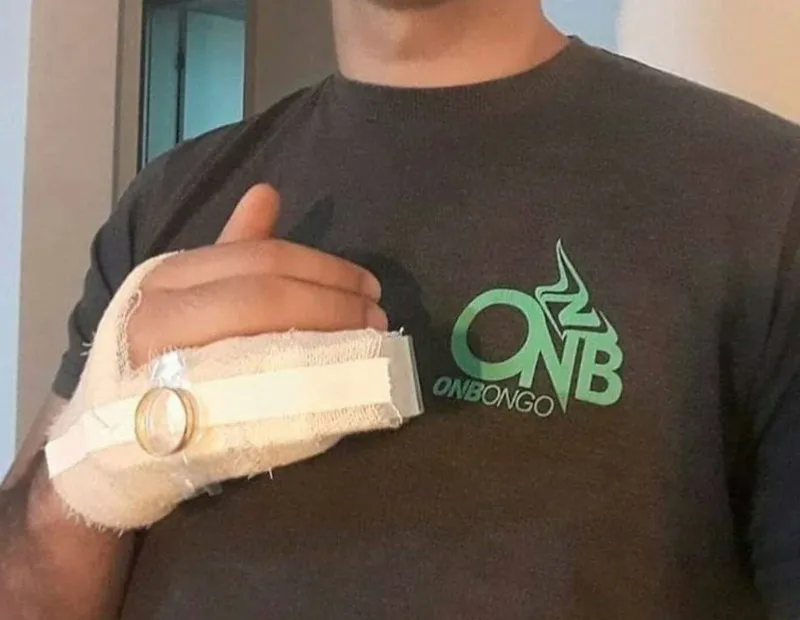 man tapes wedding ring over hand cast