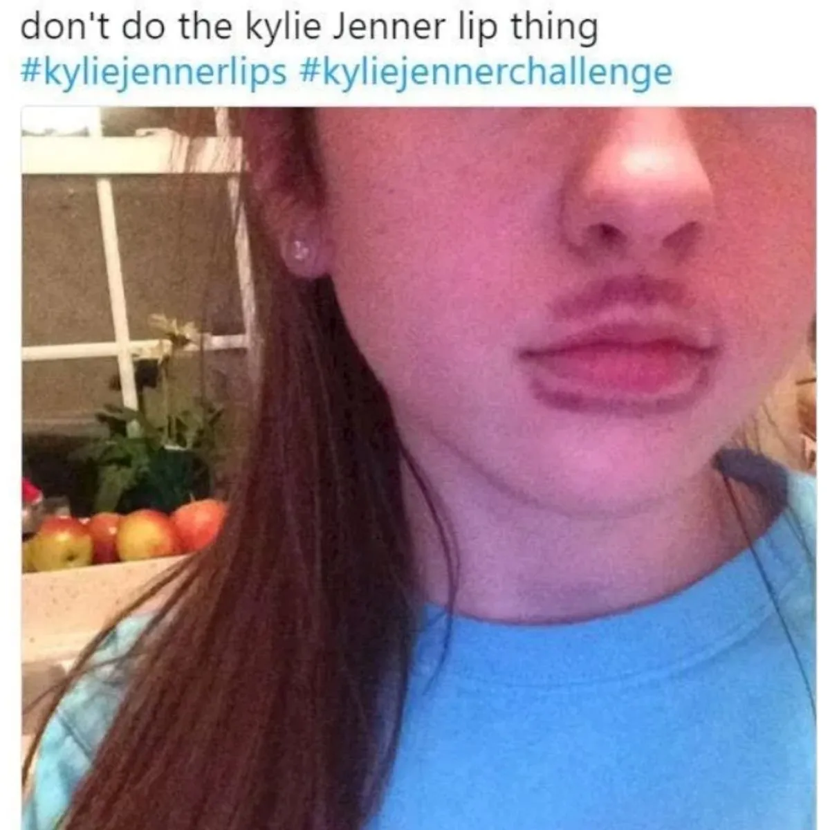 Girl with bruised lips after attempting the kylie jenner lip challenge