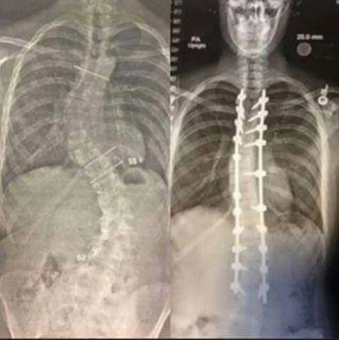 x-rays show before (crooked spine) and after (spine straighter with rods) 