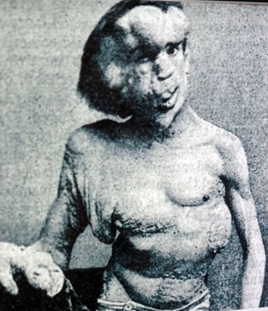 Photograph of Joseph Merrick. Joseph Carey Merrick (1862-1890) an English man who suffered with severe deformities. 