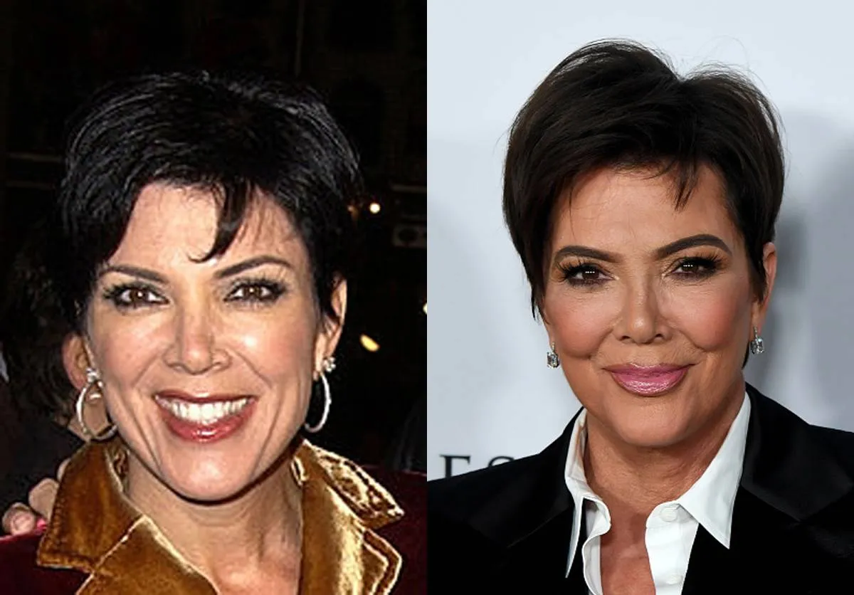 kris-jenner-before-after-plastic-surgery