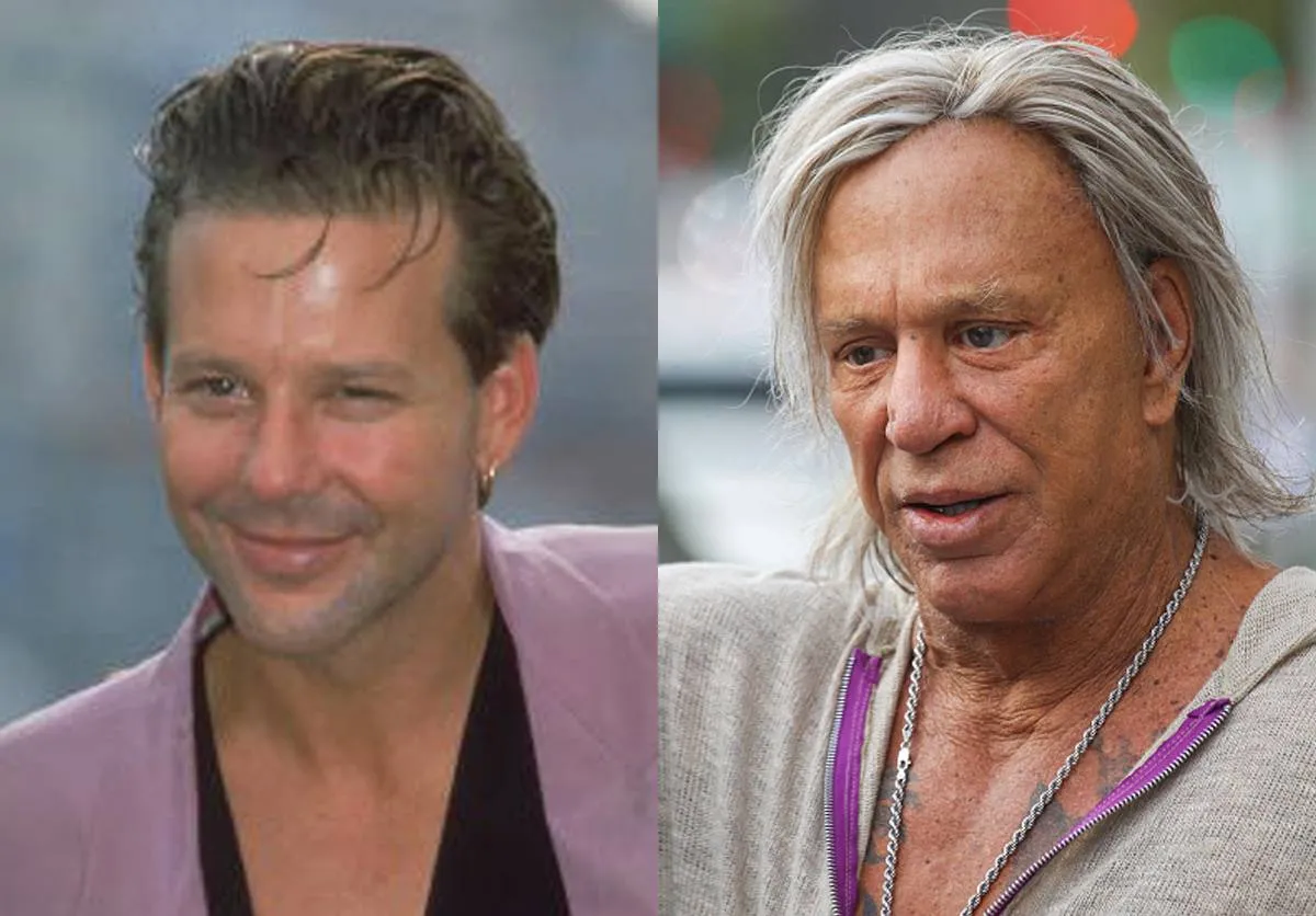 mickey-rourke-before-after-plastic-surgery