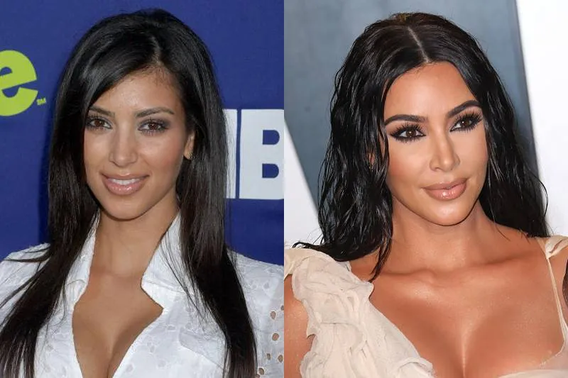 kim-kardashian-plastic-surgery
